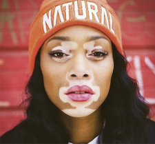 Top Model Vitiligo