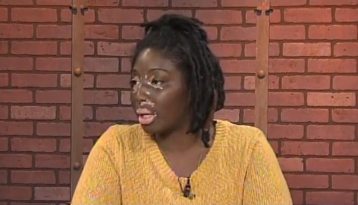 Sharon-King-vitiligo
