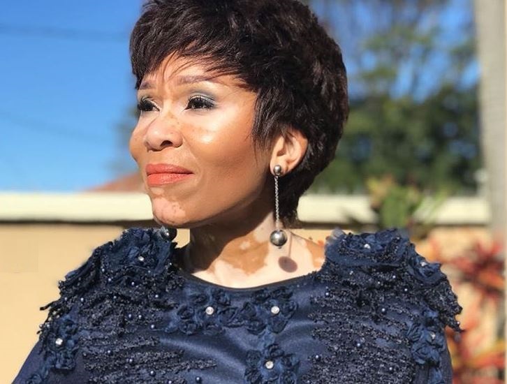 Leleti-Khumalo-vitiligo