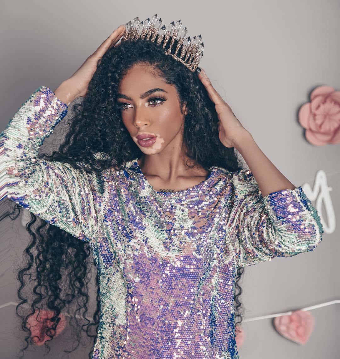 Shahad-Salman-vitiligo