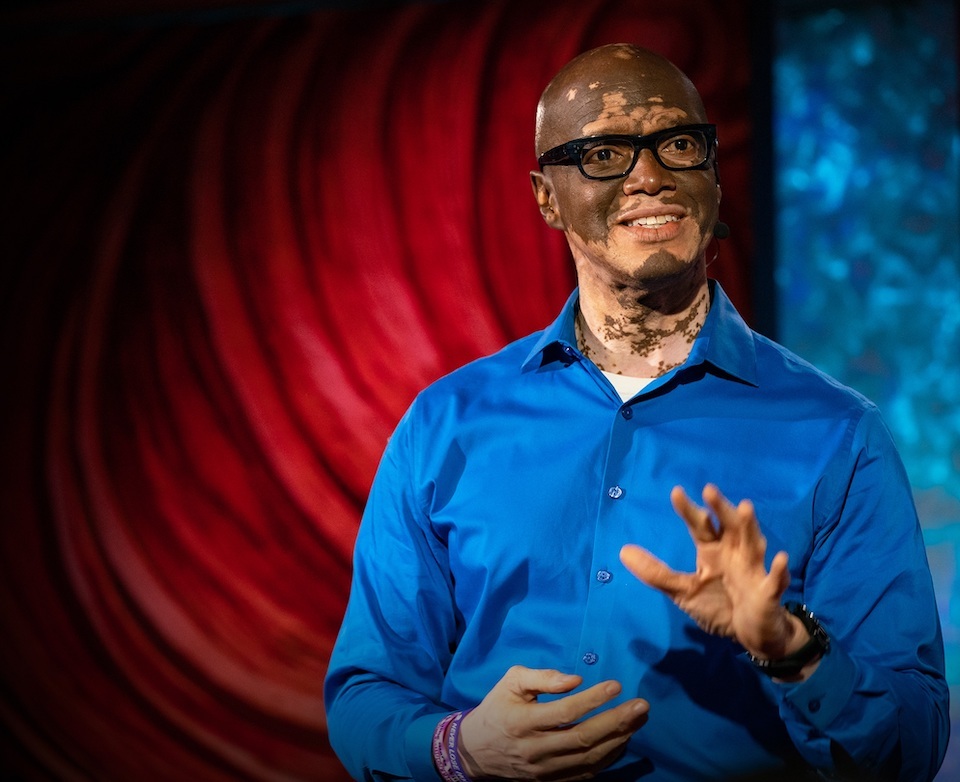 Lee-Thomas-vitiligo