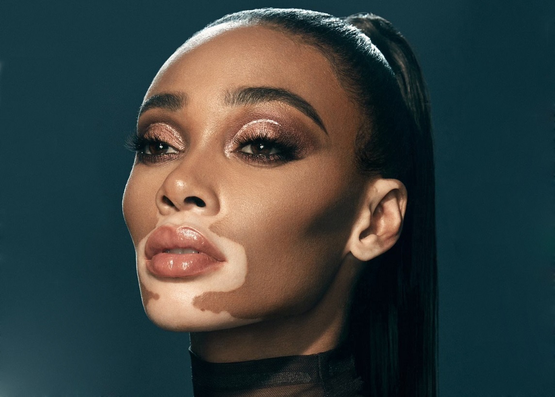 Winnie-Harlow-vitiligo
