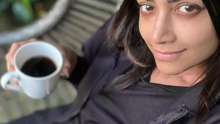 Mamta_Mohandas_vitiligo